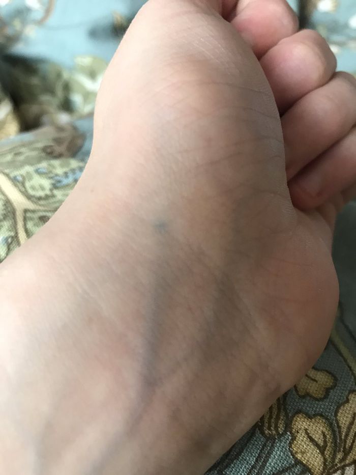 Hàng nghìn cư dân mạng đều có chung hình xăm từ vết bút chì đâm