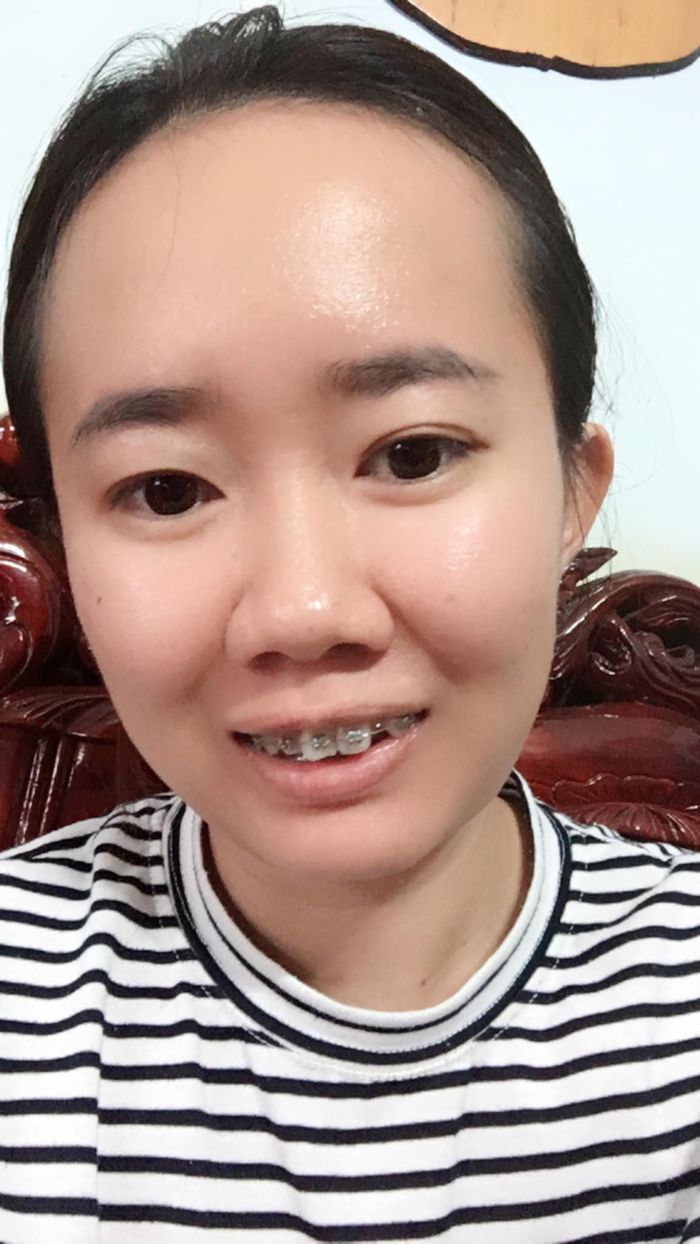 Nỗi khổ khi niềng răng, đau mấy cũng cam chịu