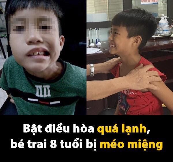 Bé trai bị liệt cơ mặt do ngủ lạnh ban đêm