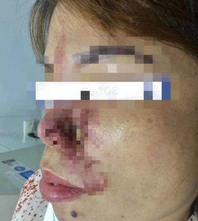 Một phụ nữ ở Hà Nội hoại tử mũi do tiêm filler làm đẹp