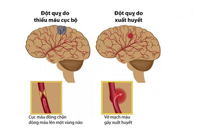 Dấu hiệu nhận biết sớm bệnh đột quỵ