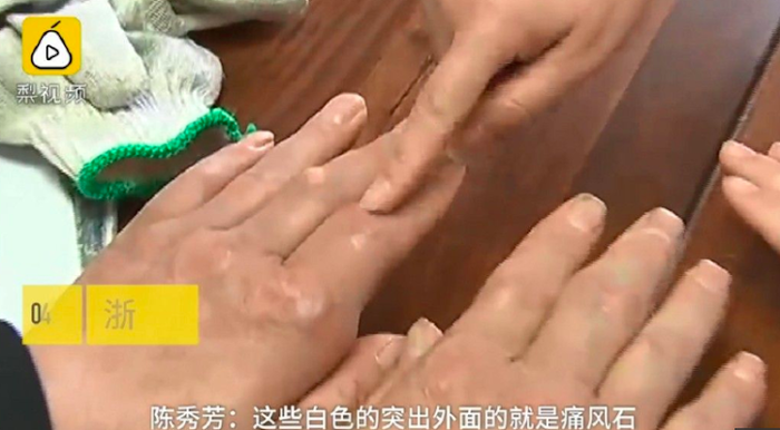 Ăn thịt, uống nước ngọt mỗi ngày, bàn tay thanh niên bị biến dạng