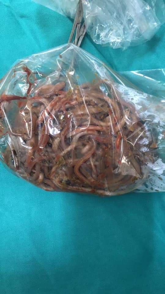 Bé 11 tuổi buồn nôn, đau dữ dội, vào cấp cứu bác sĩ lôi ra cả búi giun
