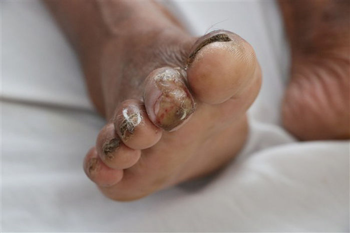 Bộ Y tế khuyến cáo cẩn thận vết thương hở, tránh virus ăn thịt người
