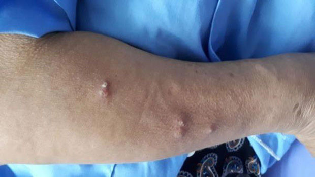 Bộ Y tế khuyến cáo cẩn thận vết thương hở, tránh virus ăn thịt người