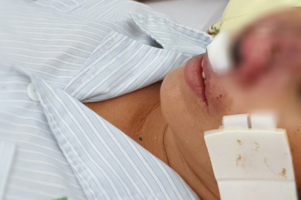 Cảnh báo vi khuẩn ăn thịt người tấn công
