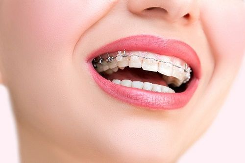 Chưa niềng thì đi một cái, niềng rồi đi luôn cả hàm