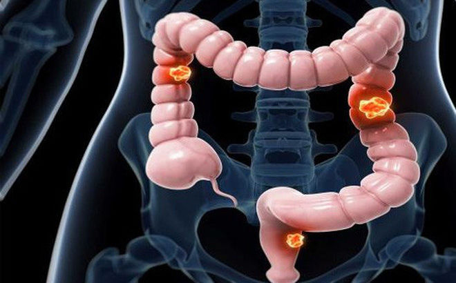 Đại tiện ra máu, đi khám thì phát hiện khối u đau đớn ở hậu môn