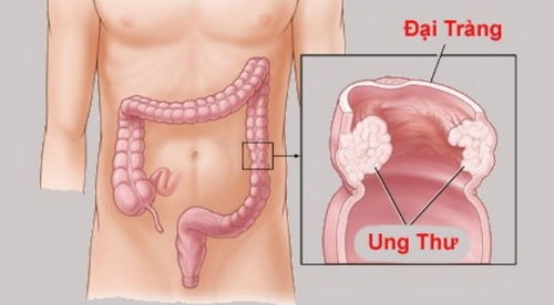 Đại tiện ra máu, đi khám thì phát hiện khối u đau đớn ở hậu môn