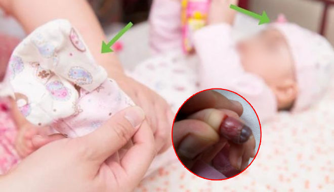 Đeo găng tay cho trẻ sơ sinh, ấm đâu không thấy chỉ hoại tử ngón tay