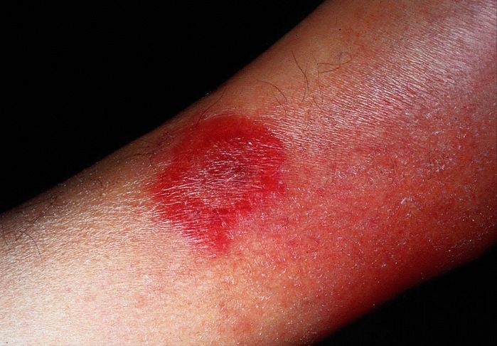 Khiếp sợ vì sự xâm lấn của vi khuẩn ăn thịt người, nhất là Clostridium