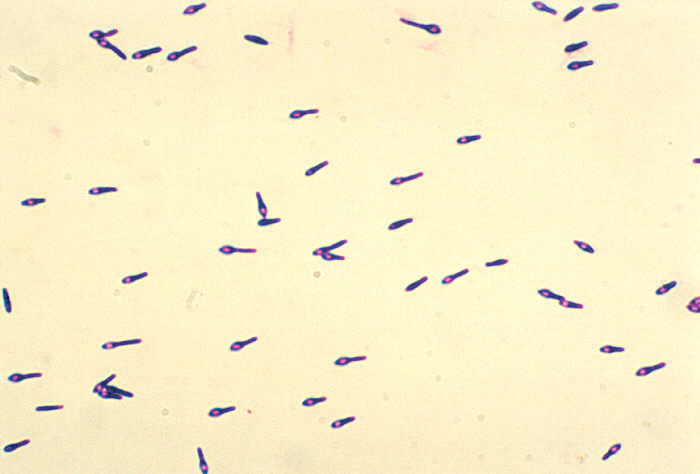 Khiếp sợ vì sự xâm lấn của vi khuẩn ăn thịt người, nhất là Clostridium