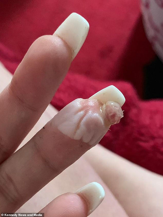 Cô gái bị nhiễm trùng suýt mất ngón tay vì thói quen sơn móng làm đẹp