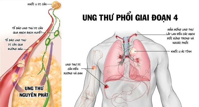 Mai Phương bị ung thư di căn vào tim