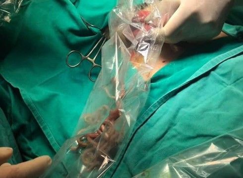 Bé 11 tuổi buồn nôn, đau dữ dội, vào cấp cứu bác sĩ lôi ra cả búi giun