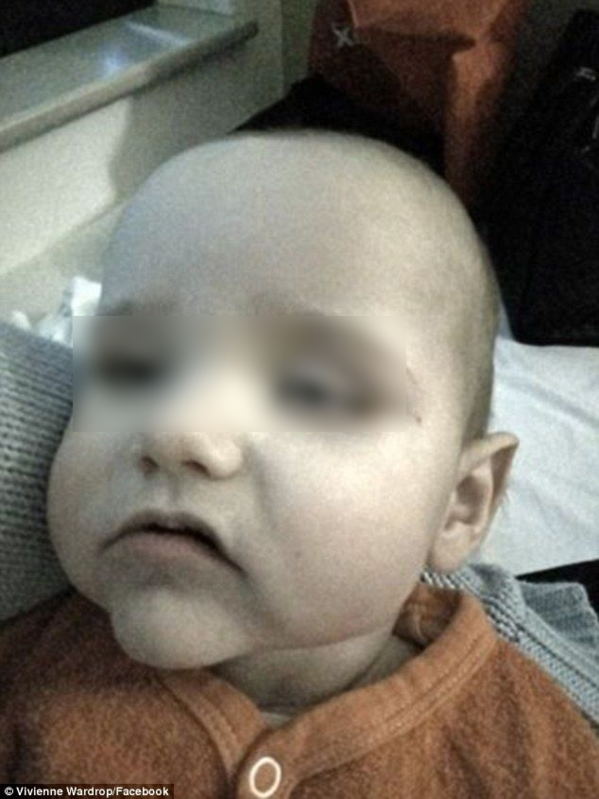 Nhiễm khuẩn vì ngồi xe đẩy siêu thị, bé trai bị chẩn đoán viêm não