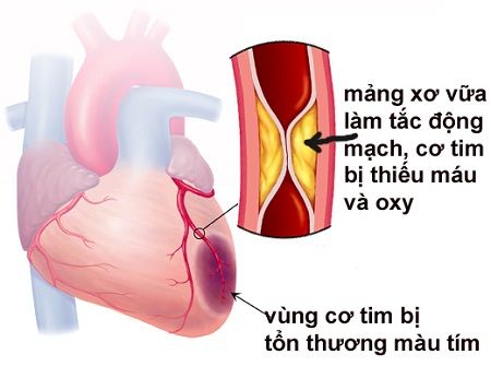 NSND Thế Anh qua đời sau nhồi máu cơ tim, đau ngực dữ dội là dấu hiệu
