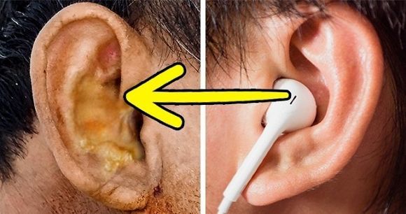 Tai nghe nhỏ, hậu quả to: Sử dụng quá 2 giờ mỗi ngày có thể gây điếc
