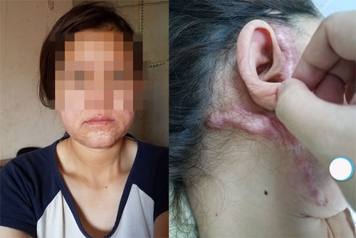 Cứng đơ, hoại tử - hậu quả khi thẩm mỹ hỏng khiến chị em hối không kịp