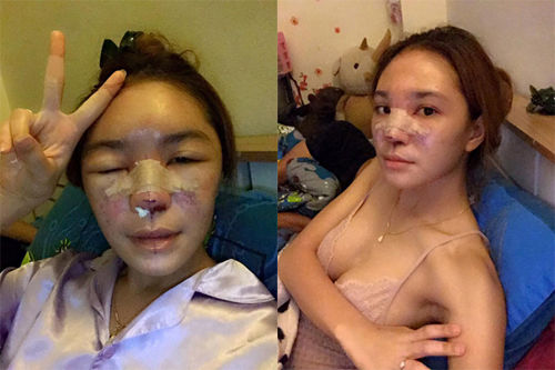 Cứng đơ, hoại tử - hậu quả khi thẩm mỹ hỏng khiến chị em hối không kịp