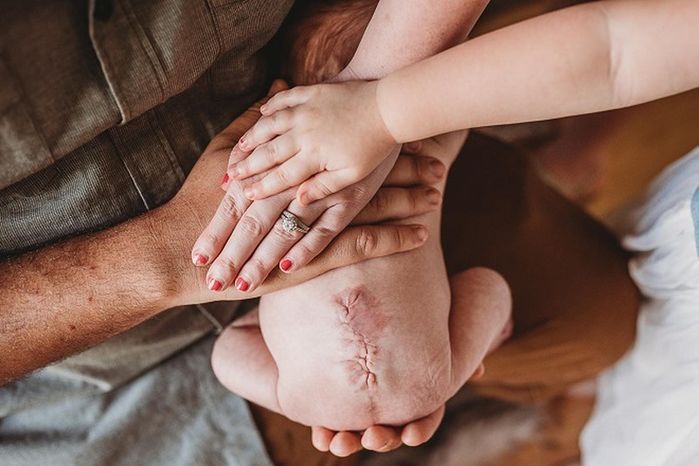 Em bé sở hữu vết sẹo lớn sau lưng vì chào đời hai lần