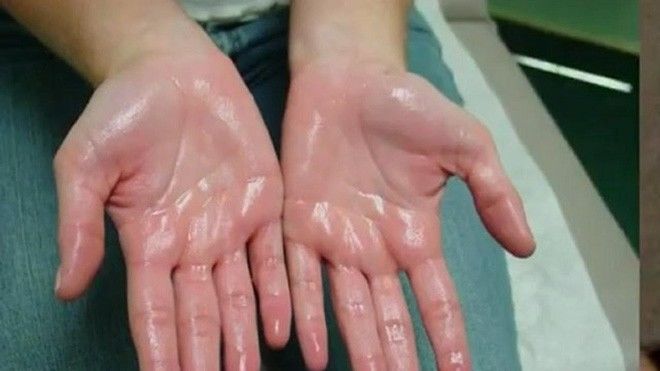 Bác sĩ bệnh viện K nhấn mạnh đổ mồ hôi ban đêm dễ ung thư