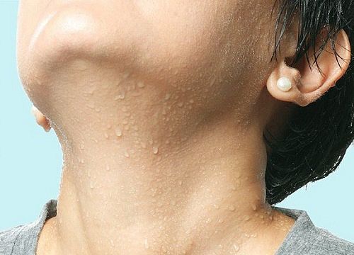 Bác sĩ bệnh viện K nhấn mạnh đổ mồ hôi ban đêm dễ ung thư