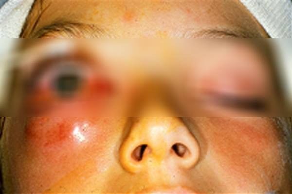 Bác Sĩ Erich Voigt: Nhổ lông mũi thường xuyên gây viêm nang lông