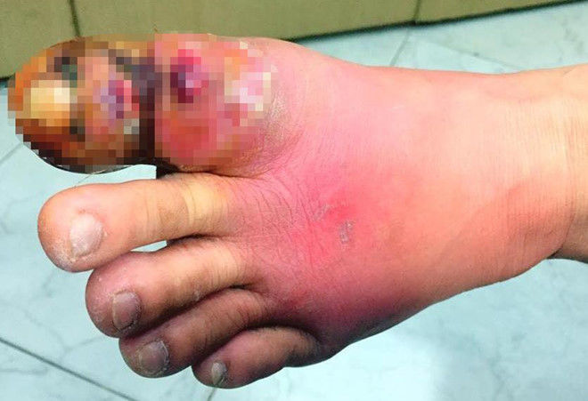 BS Masataka Saito Nhật: Cắt móng chân sai cách dễ nhiễm trùng huyết