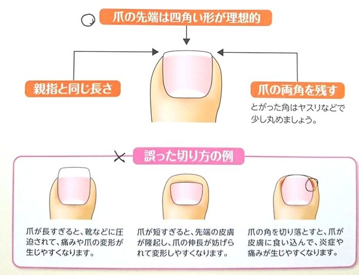 BS Masataka Saito Nhật: Cắt móng chân sai cách dễ nhiễm trùng huyết