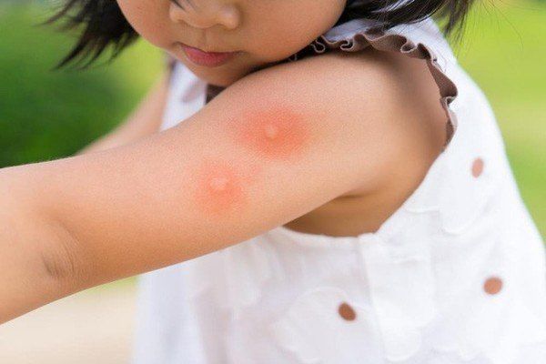 BV Nhiệt đới TW: Dịch sốt xuất huyết đang trong tình trạng báo động