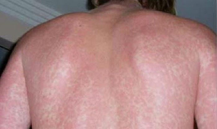 BV Nhiệt đới TW: Dịch sốt xuất huyết đang trong tình trạng báo động