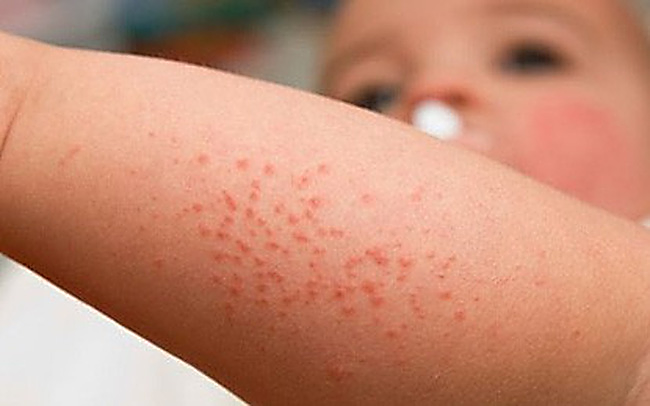 BV Nhiệt đới TW: Dịch sốt xuất huyết đang trong tình trạng báo động