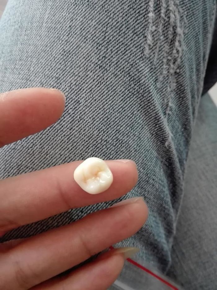 Lỡ vả chồng gãy răng, vợ làm luôn cho cái nhẫn mới để dằn mặt