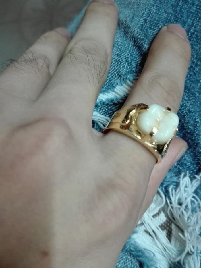 Lỡ vả chồng gãy răng, vợ làm luôn cho cái nhẫn mới để dằn mặt