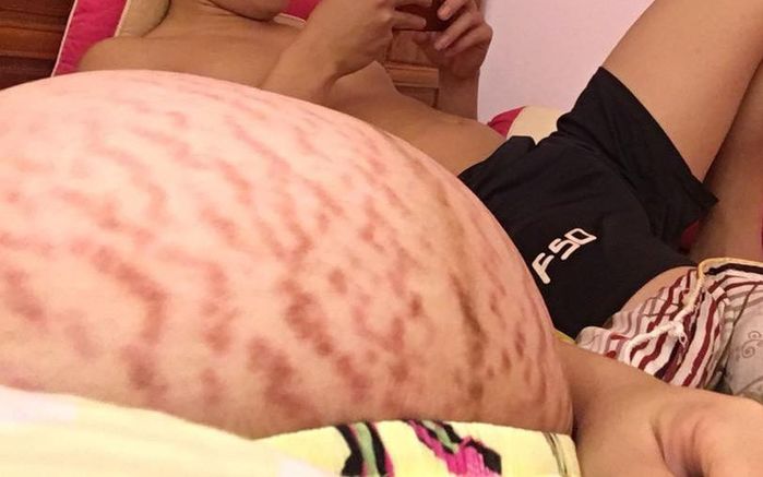 Mẹ bầu bụng rạn như ngựa vằn, ai xem cũng không khỏi kinh ngạc xót xa
