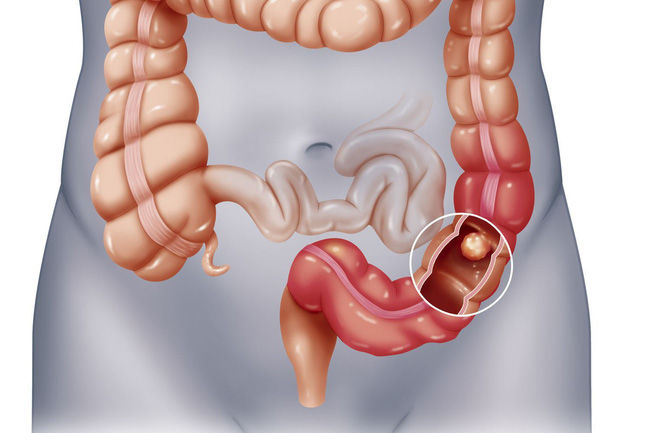 Người phụ nữ suýt mất mạng vì bị tắc ruột sau khi ăn quả hồng giòn