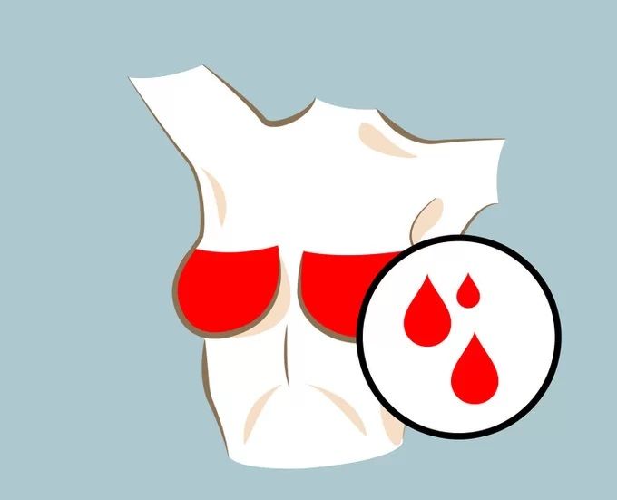 Ngực tiết dịch, đau tức dấu hiệu bất thường không thể lơ là