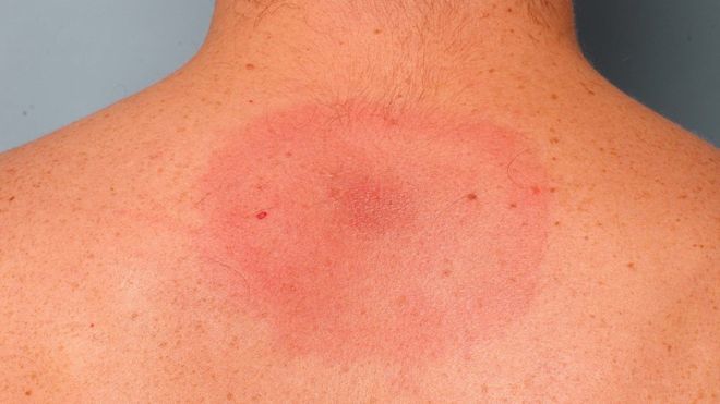 Gia tộc Hadid giàu có phải chiến đấu với căn bệnh Lyme khó chữa trị