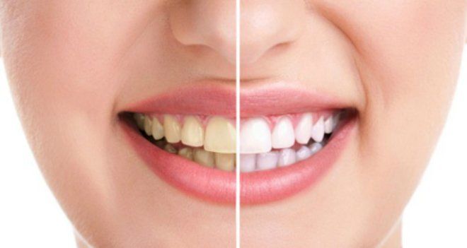 Hậu quả nghiến răng ken két khi ngủ: Rụng răng, biến dạng khớp hàm