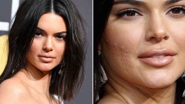 Bí kíp trị mụn hiệu quả của Kendall Jenner: Không quên kem trị mụn
