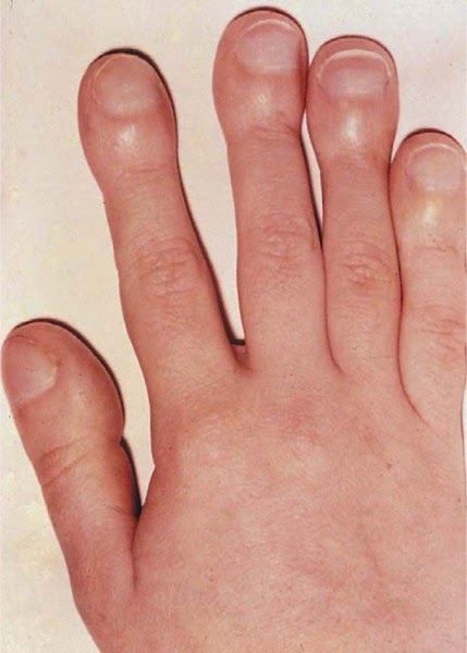 Bị nổi cục gồ ghề trên da là dấu hiệu cơ thể đang nuôi ung thư
