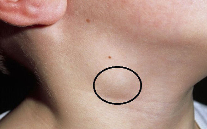 Bị nổi cục gồ ghề trên da là dấu hiệu cơ thể đang nuôi ung thư