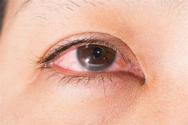 Chơi điện thoại suốt đêm, cô gái suýt mất thị lực vì bong võng mạc