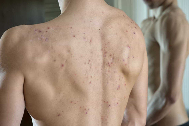 Viêm nang lông, rối loạn nội tiết...tác hại nghiêm trọng của mụn lưng