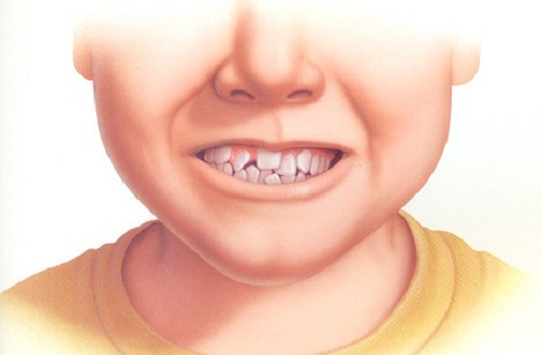 Nếu trẻ ngồi kiểu W, ít giao tiếp mắt thì bố mẹ phải đặc biệt lưu ý