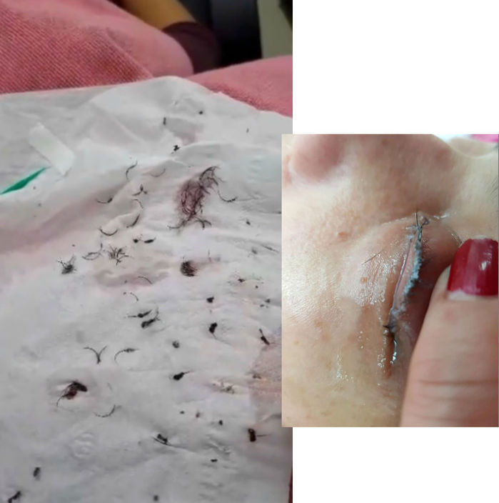 BS Rebecca J. Taylor: Nối mi sai cách dễ sưng đỏ, nhiễm trùng, rụng mi