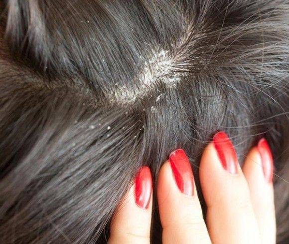 Dị ứng khi nhuộm tóc có thể dẫn đến biến dạng mặt, thậm chí là tử vong