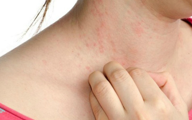 5 vấn đề sức khỏe năm 2019, đáng sợ nhất là vi khuẩn ăn thịt người