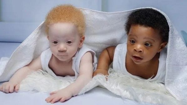 BS trố mắt vì cặp song sinh khác biệt 100% từ màu da đến mái tóc